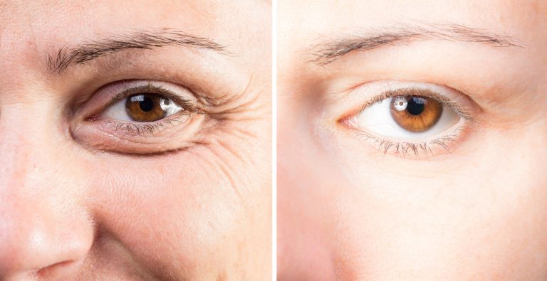 Here Is What You Should Know About Under Eye Botox Before And After